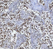 IHC staining of FFPE human lung cancer tissue with DAPK1 antibody. HIER: boil tissue sections in pH8 EDTA for 20 min and allow to cool before testing.