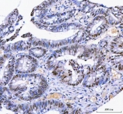IHC staining of FFPE human rectum adenocarcinoma tissue with IFFO1 antibody. HIER: boil tissue sections in pH8 EDTA for 20 min and allow to cool before testing.