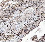 IHC staining of FFPE human esophageal squamous carcinoma tissue with ILF2 antibody. HIER: boil tissue sections in pH8 EDTA for 20 min and allow to cool before testing.