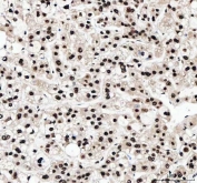 IHC staining of FFPE human liver cancer tissue with ILF2 antibody. HIER: boil tissue sections in pH8 EDTA for 20 min and allow to cool before testing.
