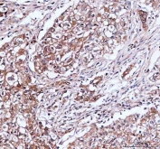 IHC staining of FFPE human lung cancer tissue with IDI1 antibody. HIER: boil tissue sections in pH8 EDTA for 20 min and allow to cool before testing.