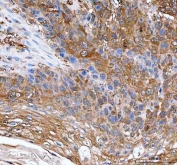 IHC staining of FFPE human esophageal squamous carcinoma tissue with IDI1 antibody. HIER: boil tissue sections in pH8 EDTA for 20 min and allow to cool before testing.
