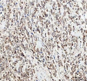 IHC staining of FFPE human breast cancer tissue with MTF1 antibody. HIER: boil tissue sections in pH8 EDTA for 20 min and allow to cool before testing.