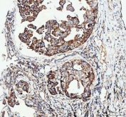 IHC staining of FFPE human lung cancer tissue with Pyruvate dehydrogenase kinase 4 antibody. HIER: boil tissue sections in pH8 EDTA for 20 min and allow to cool before testing.
