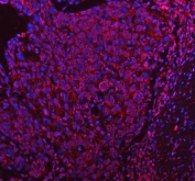 Immunofluorescent staining of FFPE human squamous cell carcinoma tissue with Pyruvate dehydrogenase kinase 4 antibody (red) and DAPI nuclear stain (blue). HIER: steam section in pH8 EDTA buffer for 20 min.
