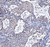 IHC staining of FFPE human lung cancer tissue with LRRC75B antibody. HIER: boil tissue sections in pH8 EDTA for 20 min and allow to cool before testing.