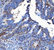 IHC staining of FFPE human colorectal adenocarcinoma tissue with LRRC75B antibody. HIER: boil tissue sections in pH8 EDTA for 20 min and allow to cool before testing.