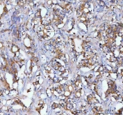 IHC staining of FFPE human prostatic acinar adenocarcinoma tissue with MOGAT2 antibody. HIER: boil tissue sections in pH8 EDTA for 20 min and allow to cool before testing.
