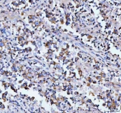 IHC staining of FFPE human testicular germ cell tumor tissue with MOGAT2 antibody. HIER: boil tissue sections in pH8 EDTA for 20 min and allow to cool before testing.