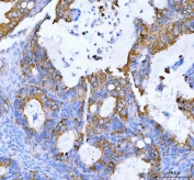 IHC staining of FFPE human ovarian serous adenocarcinoma tissue with MOGAT2 antibody. HIER: boil tissue sections in pH8 EDTA for 20 min and allow to cool before testing.
