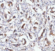 IHC staining of FFPE human breast cancer tissue with MOGAT2 antibody. HIER: boil tissue sections in pH8 EDTA for 20 min and allow to cool before testing.