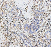 IHC staining of FFPE human rectum adenocarcinoma tissue with MOGAT2 antibody. HIER: boil tissue sections in pH8 EDTA for 20 min and allow to cool before testing.