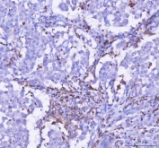 IHC staining of FFPE human lung cancer tissue with LPCAT2 antibody. HIER: boil tissue sections in pH8 EDTA for 20 min and allow to cool before testing.