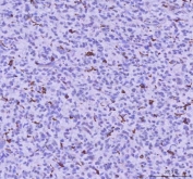 IHC staining of FFPE human glioma tissue with LPCAT2 antibody. HIER: boil tissue sections in pH8 EDTA for 20 min and allow to cool before testing.