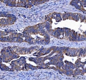 IHC staining of FFPE human colorectal adenocarcinoma tissue with LGI4 antibody. HIER: boil tissue sections in pH8 EDTA for 20 min and allow to cool before testing.