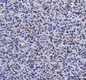 IHC staining of FFPE human glioma tissue with LGI4 antibody. HIER: boil tissue sections in pH8 EDTA for 20 min and allow to cool before testing.