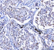 IHC staining of FFPE human lung cancer tissue with LGI4 antibody. HIER: boil tissue sections in pH8 EDTA for 20 min and allow to cool before testing.