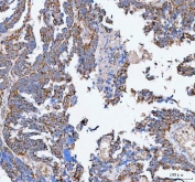 IHC staining of FFPE human ovarian serous adenocarcinoma tissue with Pellino-3 antibody. HIER: boil tissue sections in pH8 EDTA for 20 min and allow to cool before testing.