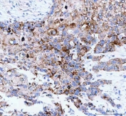 IHC staining of FFPE human esophageal squamous carcinoma tissue with Josephin 2 antibody. HIER: boil tissue sections in pH8 EDTA for 20 min and allow to cool before testing.