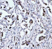 IHC staining of FFPE human breast cancer tissue with LEO1 antibody. HIER: boil tissue sections in pH8 EDTA for 20 min and allow to cool before testing.