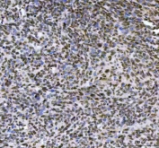 IHC staining of FFPE human cervical squamous carcinoma tissue with LEO1 antibody. HIER: boil tissue sections in pH8 EDTA for 20 min and allow to cool before testing.