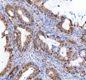 IHC staining of FFPE human ovarian serous adenocarcinoma tissue with LEO1 antibody. HIER: boil tissue sections in pH8 EDTA for 20 min and allow to cool before testing.