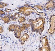IHC staining of FFPE human prostate cancer tissue with LZIC antibody. HIER: boil tissue sections in pH8 EDTA for 20 min and allow to cool before testing.