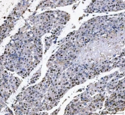 IHC staining of FFPE human liver cancer tissue with L3MBTL2 antibody. HIER: boil tissue sections in pH8 EDTA for 20 min and allow to cool before testing.