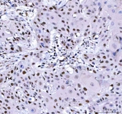 IHC staining of FFPE human esophageal squamous carcinoma tissue with L3MBTL2 antibody. HIER: boil tissue sections in pH8 EDTA for 20 min and allow to cool before testing.