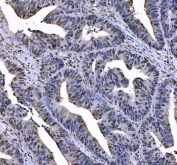 IHC staining of FFPE human colorectal adenocarcinoma tissue with L3MBTL2 antibody. HIER: boil tissue sections in pH8 EDTA for 20 min and allow to cool before testing.