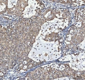 IHC staining of FFPE human lung cancer tissue with LRRC59 antibody. HIER: boil tissue sections in pH8 EDTA for 20 min and allow to cool before testing.