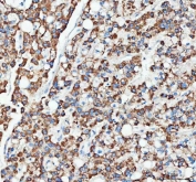 IHC staining of FFPE human liver cancer tissue with OTUB1 antibody. HIER: boil tissue sections in pH8 EDTA for 20 min and allow to cool before testing.