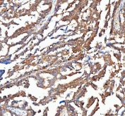 IHC staining of FFPE human ovarian cancer tissue with OTUB1 antibody. HIER: boil tissue sections in pH8 EDTA for 20 min and allow to cool before testing.
