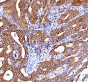 IHC staining of FFPE human rectum adenocarcinoma tissue with OTUB1 antibody. HIER: boil tissue sections in pH8 EDTA for 20 min and allow to cool before testing.