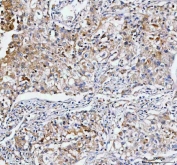IHC staining of FFPE human lung cancer tissue with CMG-1 antibody. HIER: boil tissue sections in pH8 EDTA for 20 min and allow to cool before testing.