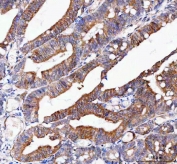 IHC staining of FFPE human rectum adenocarcinoma tissue with CMG-1 antibody. HIER: boil tissue sections in pH8 EDTA for 20 min and allow to cool before testing.