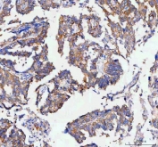 IHC staining of FFPE human ovarian serous adenocarcinoma tissue with RAB3IP antibody. HIER: boil tissue sections in pH8 EDTA for 20 min and allow to cool before testing.