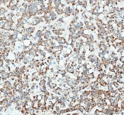 IHC staining of FFPE human liver cancer tissue with RAB3IP antibody. HIER: boil tissue sections in pH8 EDTA for 20 min and allow to cool before testing.