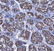 IHC staining of FFPE human liver cancer tissue with LDAH antibody. HIER: boil tissue sections in pH8 EDTA for 20 min and allow to cool before testing.