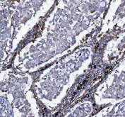 IHC staining of FFPE human lung cancer tissue with LDAH antibody. HIER: boil tissue sections in pH8 EDTA for 20 min and allow to cool before testing.