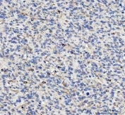IHC staining of FFPE human glioma tissue with LDAH antibody. HIER: boil tissue sections in pH8 EDTA for 20 min and allow to cool before testing.
