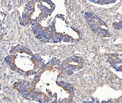 IHC staining of FFPE human rectum adenocarcinoma tissue with MCCC2 antibody. HIER: boil tissue sections in pH8 EDTA for 20 min and allow to cool before testing.