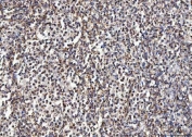 IHC staining of FFPE human intestinal diffuse large B-cell lymphoma tissue with MCCC2 antibody. HIER: boil tissue sections in pH8 EDTA for 20 min and allow to cool before testing.