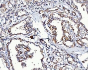 IHC staining of FFPE human thyroid cancer tissue with MCCC2 antibody. HIER: boil tissue sections in pH8 EDTA for 20 min and allow to cool before testing.