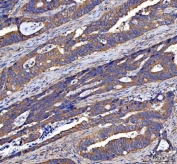 IHC staining of FFPE human colorectal adenocarcinoma tissue with LIN7C antibody. HIER: boil tissue sections in pH8 EDTA for 20 min and allow to cool before testing.