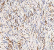 IHC staining of FFPE human meningioma tissue with BPNT2 antibody. HIER: boil tissue sections in pH8 EDTA for 20 min and allow to cool before testing.