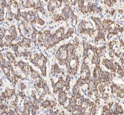 IHC staining of FFPE human lung cancer tissue with BPNT2 antibody. HIER: boil tissue sections in pH8 EDTA for 20 min and allow to cool before testing.