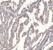 IHC staining of FFPE human ovarian cancer tissue with BPNT2 antibody. HIER: boil tissue sections in pH8 EDTA for 20 min and allow to cool before testing.