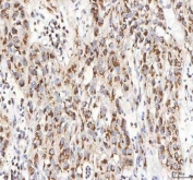 IHC staining of FFPE human urothelial carcinoma tissue with BPNT2 antibody. HIER: boil tissue sections in pH8 EDTA for 20 min and allow to cool before testing.