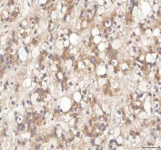 IHC staining of FFPE human liver cancer tissue with BPNT2 antibody. HIER: boil tissue sections in pH8 EDTA for 20 min and allow to cool before testing.